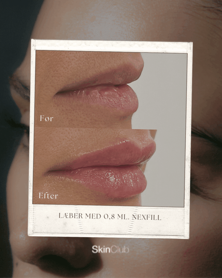 Botox Fillers Kolding København SkinClub
