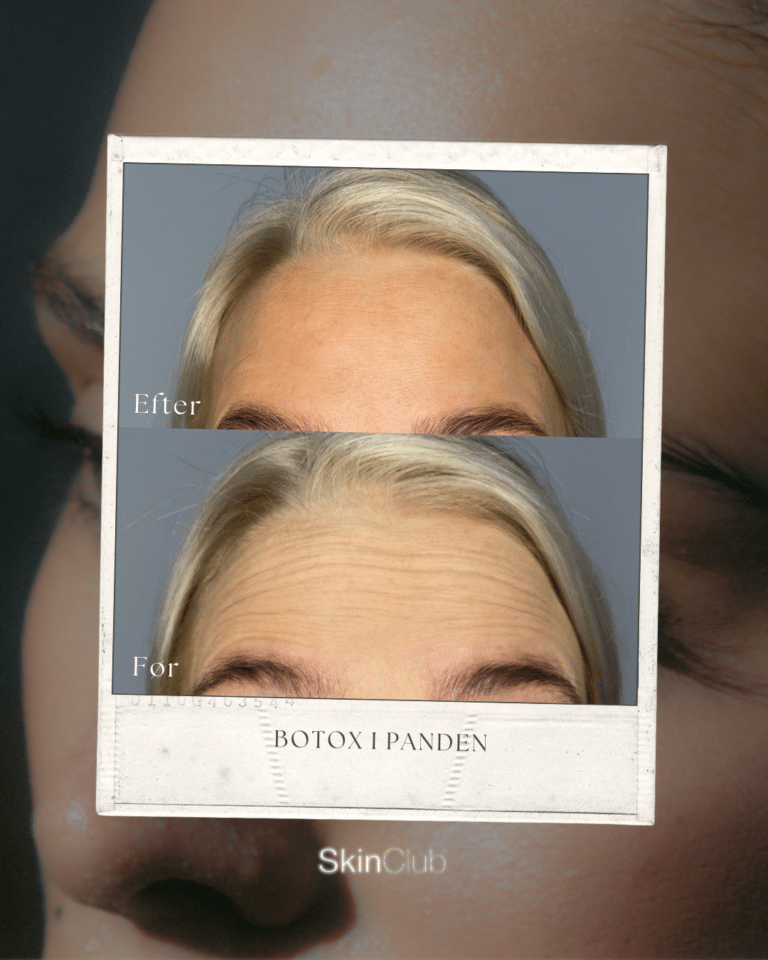 Rynkebehandling med botox før & efter bekymringsrynke