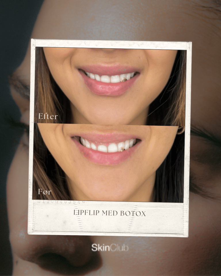 Rynkebehandling med botox før & efter bekymringsrynke