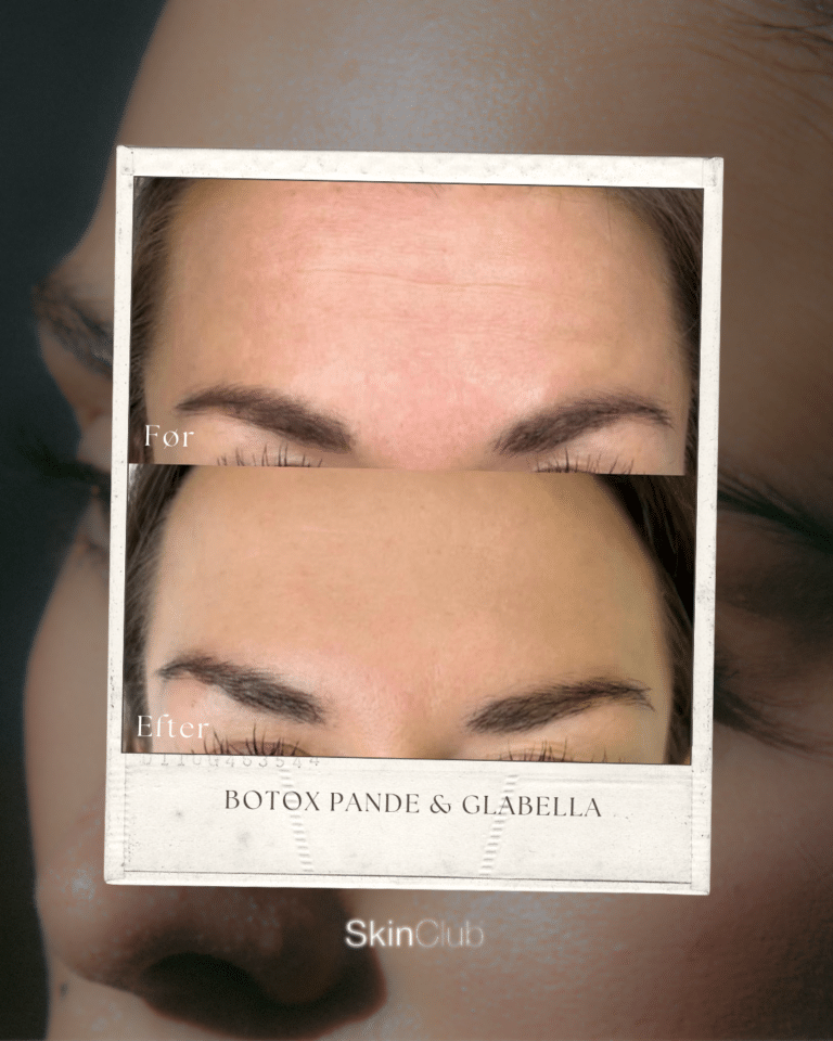 Rynkebehandling med botox før & efter bekymringsrynke