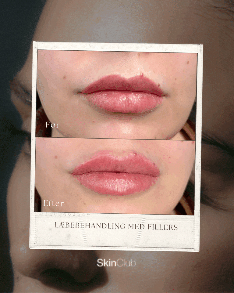 Botox Fillers Kolding København SkinClub