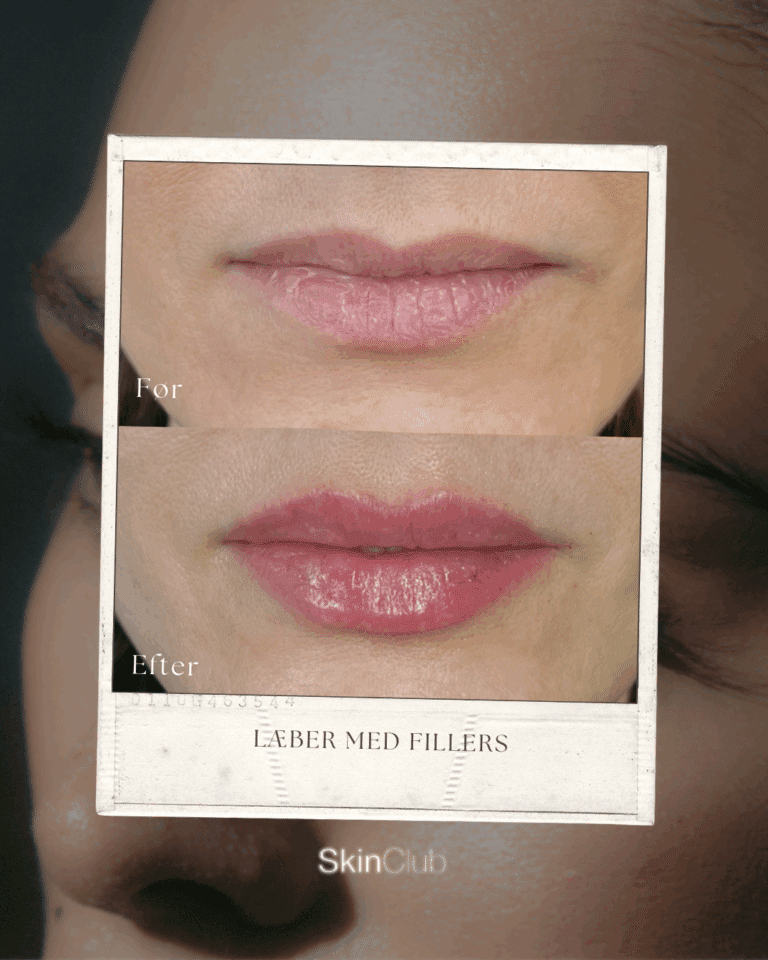 Botox Fillers Kolding København SkinClub
