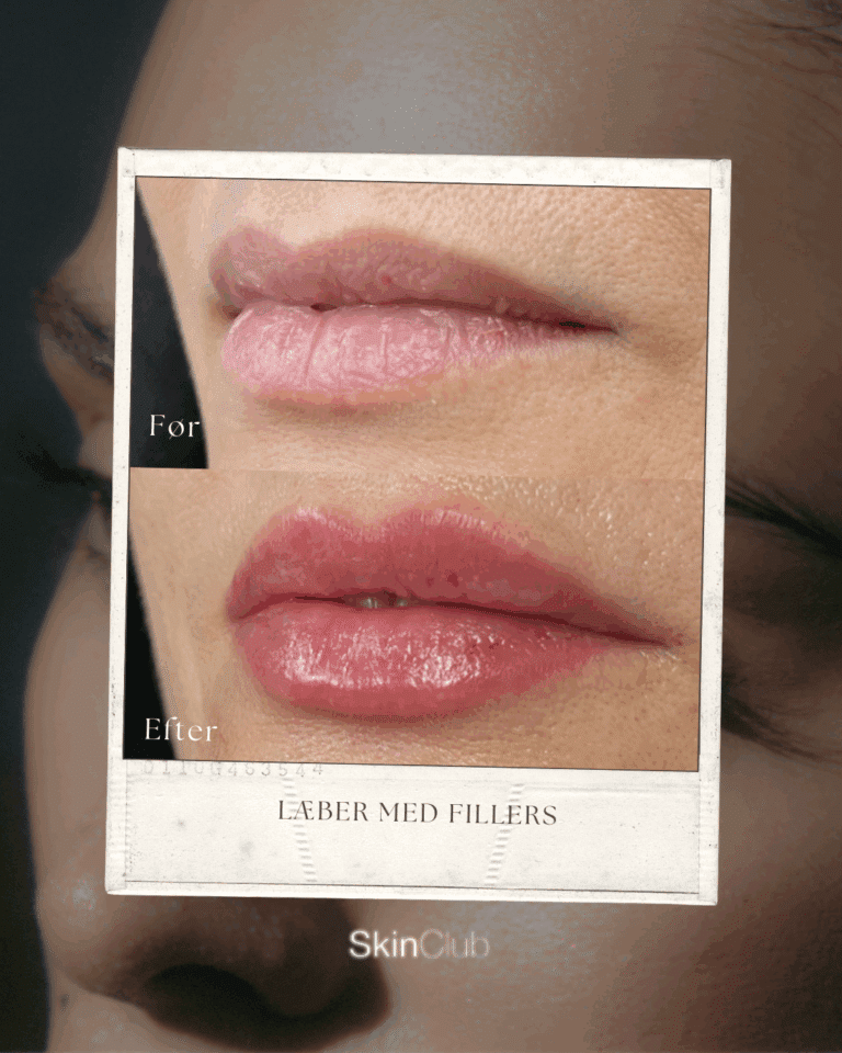 Botox Fillers Kolding København SkinClub